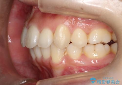【八重歯・重度のがたつきでお悩みの方必見】抜歯矯正症例(審美ワイヤー矯正)の治療後