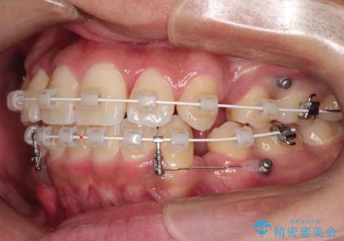 【八重歯・がたつきでお悩みの方必見】抜歯矯正症例(審美ワイヤー矯正)の治療中