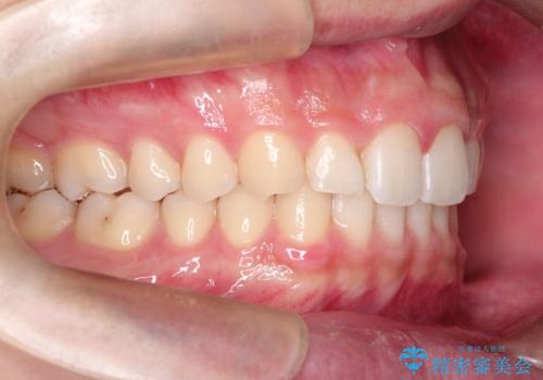 【過蓋咬合・正中離開・奥歯のズレでお悩みの方必見】非抜歯矯正症例(顎骨の成長を利用)の治療後