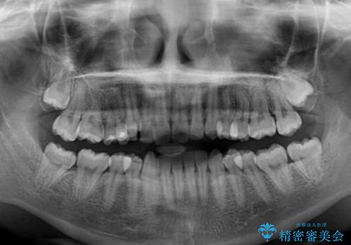 八重歯を改善 目立たないワイヤー装置での矯正治療の治療前