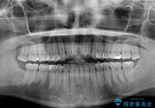 前歯の捻れを改善 インビザラインによる矯正治療の治療前