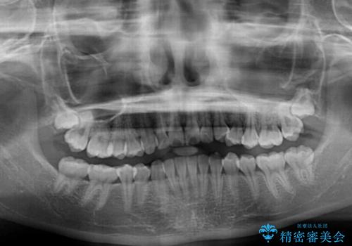 むし歯になりやすい奥歯 補助装置で一気に解決の治療前