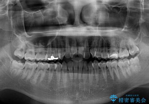 非抜歯ワイヤー装置による、短期間での矯正治療の治療前