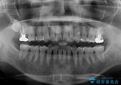 抜歯矯正の後戻りをインビザライン・ライトで解消の治療前