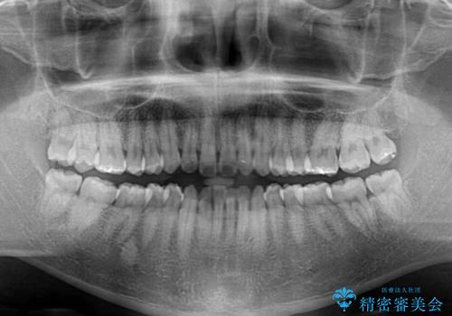 インビザラインで奥歯の咬み合わせと前歯のデコボコを改善の治療前