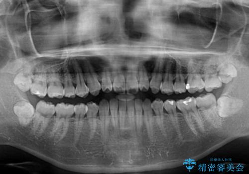 インビザラインで口を閉じやすくの治療前