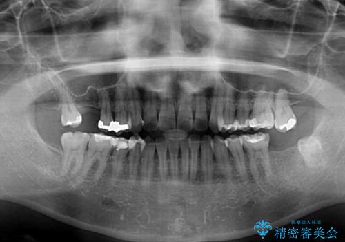 後戻りの再矯正治療と欠損部の補綴治療の治療前