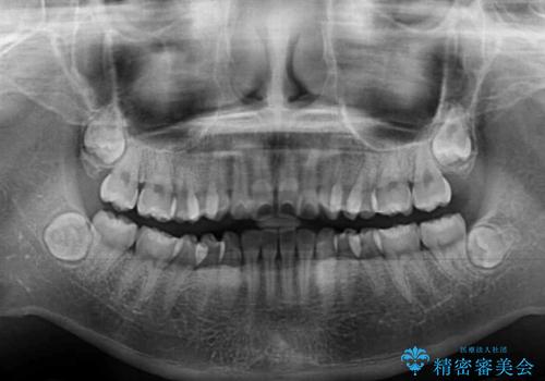 カリエール・ディスタライザーとインビザラインを用いた奥歯の咬み合わせ改善の治療前
