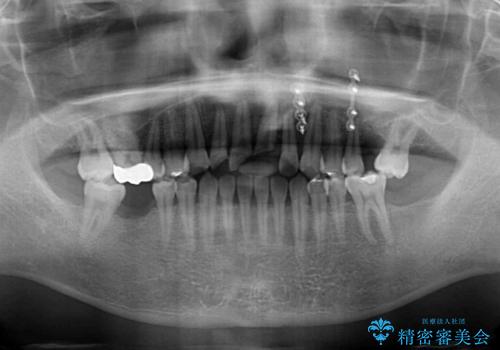 事故で抜歯となった前歯　ブリッジやインプラントによる補綴治療の治療前