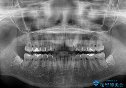 気になる残存乳歯と八重歯 ワイヤー矯正を併用したインビザライン治療の治療前