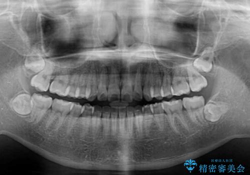 カリエール・ディスタライザーとインビザラインを用いた奥歯の咬み合わせ改善の治療後