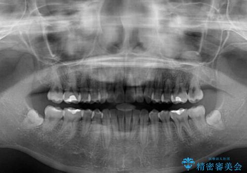 気になる残存乳歯と八重歯 ワイヤー矯正を併用したインビザライン治療の治療後