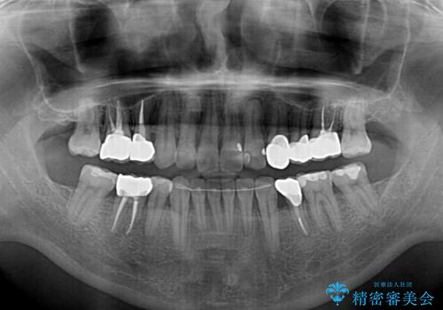 むし歯や銀歯が気になる　後戻りの再矯正治療とむし歯治療の治療後