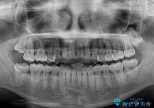 八重歯を改善　目立たないワイヤー装置での矯正治療の治療後