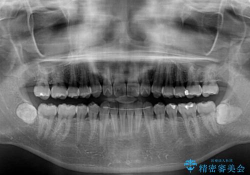 インビザラインで口を閉じやすくの治療後