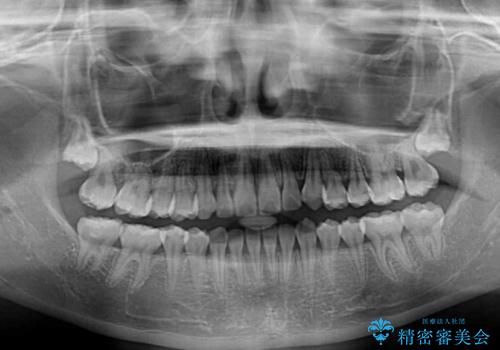 むし歯になりやすい奥歯 補助装置で一気に解決の治療後