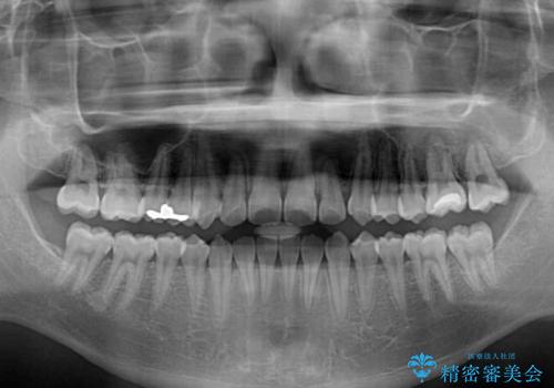 非抜歯ワイヤー装置による、短期間での矯正治療の治療後