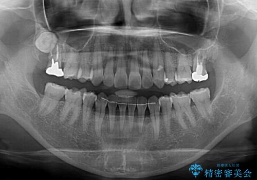 抜歯矯正の後戻りをインビザライン・ライトで解消の治療後
