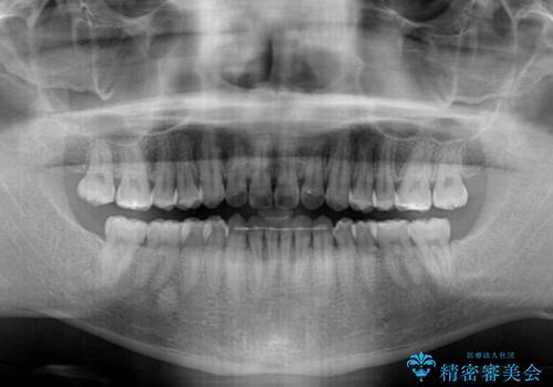 インビザラインで奥歯の咬み合わせと前歯のデコボコを改善の治療後