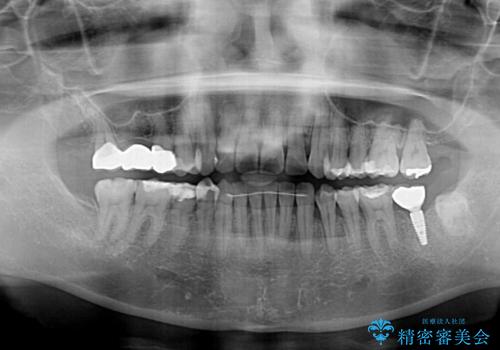 後戻りの再矯正治療と欠損部の補綴治療の治療後