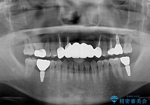 事故で抜歯となった前歯 ブリッジやインプラントによる補綴治療の治療後