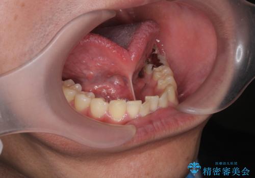 [ 舌小帯の長い付着 ]   舌の動きが悪く話しづらいの症例 治療前