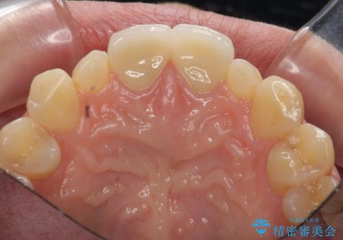 [ 前歯部セラミック治療 ]目立つ前歯をきれいにしたいの治療後