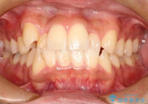 【八重歯・がたつきでお悩みの方必見】抜歯矯正症例(審美ワイヤー矯正)