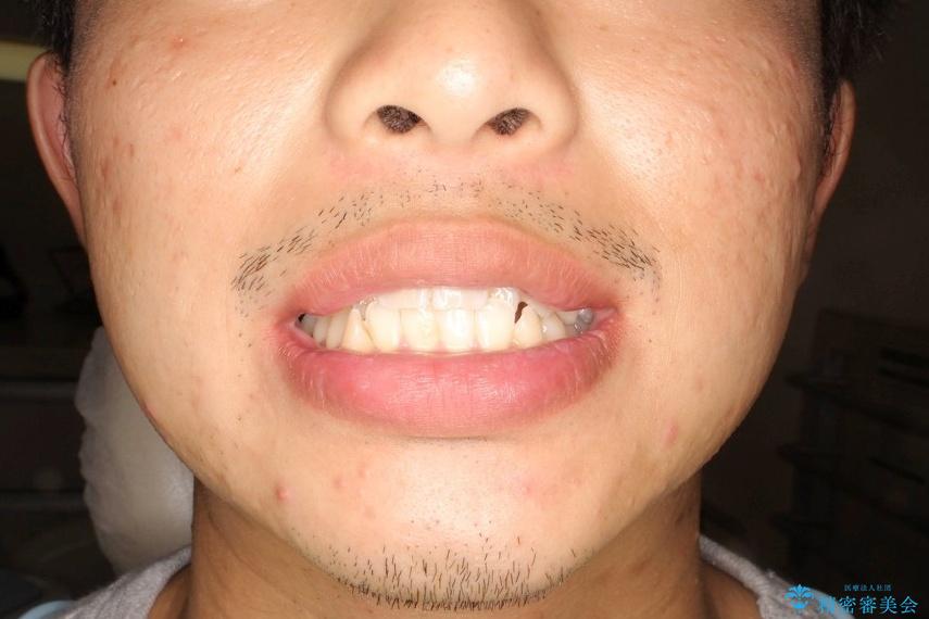 【八重歯・がたつきでお悩みの方必見】抜歯矯正症例(審美ワイヤー矯正)の治療前(顔貌)