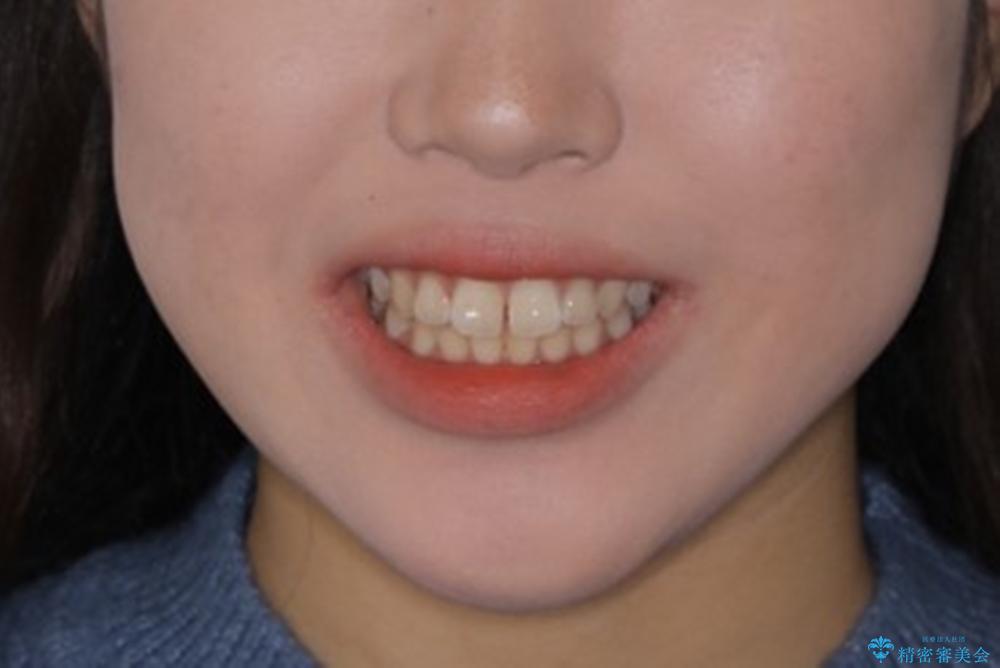 短期間ですきっ歯を改善:インビザラインLiteの治療前（顔貌）