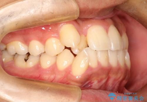 【八重歯・がたつきでお悩みの方必見】抜歯矯正症例(審美ワイヤー矯正)の治療前