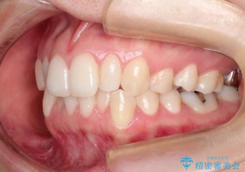 【前歯のがたつきでお悩みの方必見】インビザライン矯正の症例の治療前