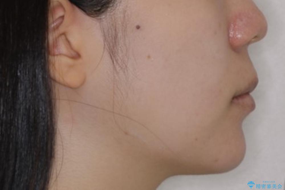 八重歯の解消とインプラントの下準備をインビザラインでの治療後(顔貌)