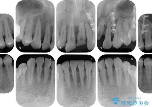 事故で抜歯となった前歯 ブリッジやインプラントによる補綴治療の治療前