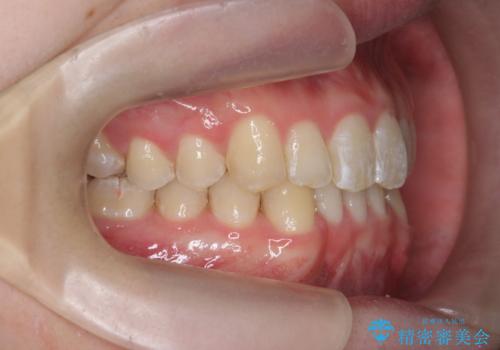クロスバイト・歯並びが原因の歯肉退縮歯、矯正治療による審美性の改善の治療後