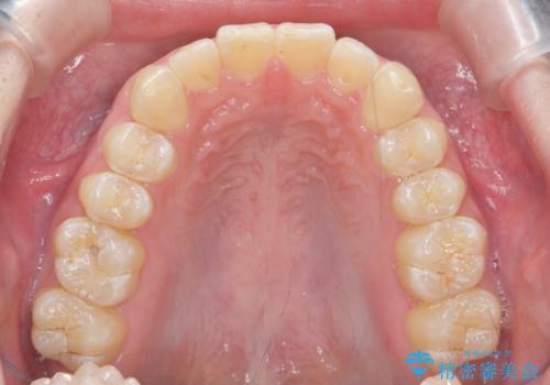 クロスバイト・歯並びが原因の歯肉退縮歯、矯正治療による審美性の改善の治療後