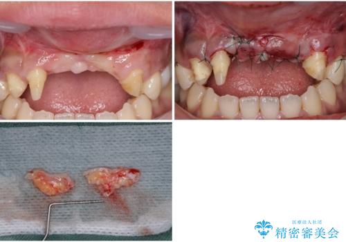 事故で抜歯となった前歯 ブリッジやインプラントによる補綴治療の治療中