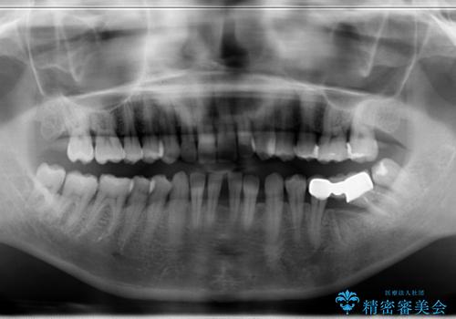 部分矯正してからオールセラミックブリッジの治療前