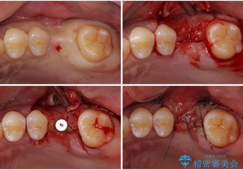事故で抜歯となった前歯 ブリッジやインプラントによる補綴治療の治療中