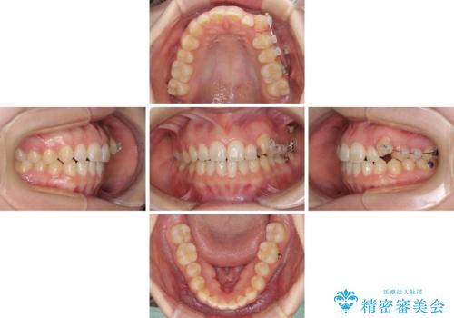 気になる残存乳歯と八重歯 ワイヤー矯正を併用したインビザライン治療の治療中