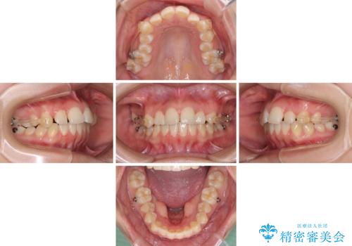 カリエール・ディスタライザーとインビザラインを用いた奥歯の咬み合わせ改善の治療中