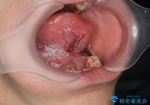 [ 舌小帯の長い付着 ]   舌の動きが悪く話しづらいの治療中