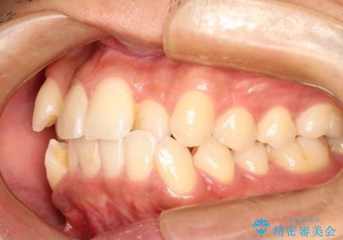 【八重歯・がたつきでお悩みの方必見】抜歯矯正症例(審美ワイヤー矯正)の治療前