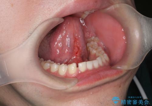 [ 舌小帯の形成術 ]ベロの動きを改善したいの治療後