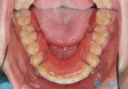 ガタつきの大きい前歯 インビザラインによるマウスピース矯正治療の治療後
