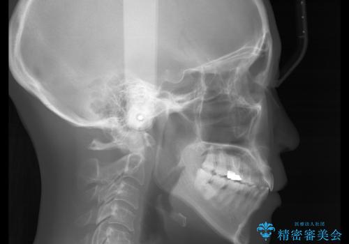 歯ぐき、骨が薄い方のマウスピース矯正治療 非抜歯でもIPR(歯を削る処置)で口元に変化をの治療後