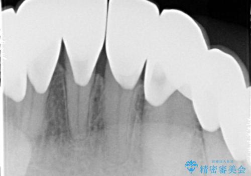 【オールセラミッククラウン】ダイレクトボンディングからのやりかえの治療後