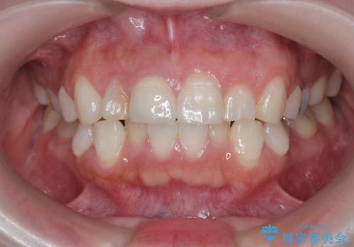 前歯の変色　セラミッククラウンによる審美性の回復の治療後