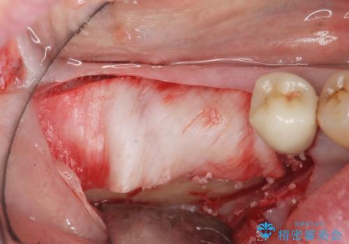 骨の造成を同時に行うインプラント治療の治療前