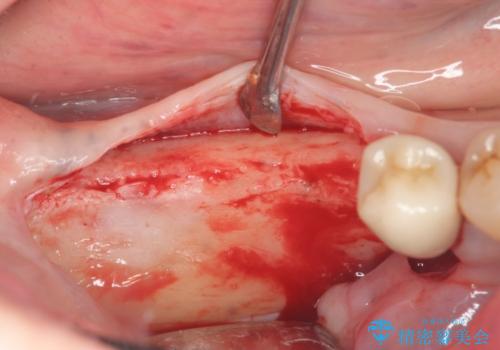 骨の造成を同時に行うインプラント治療の治療前